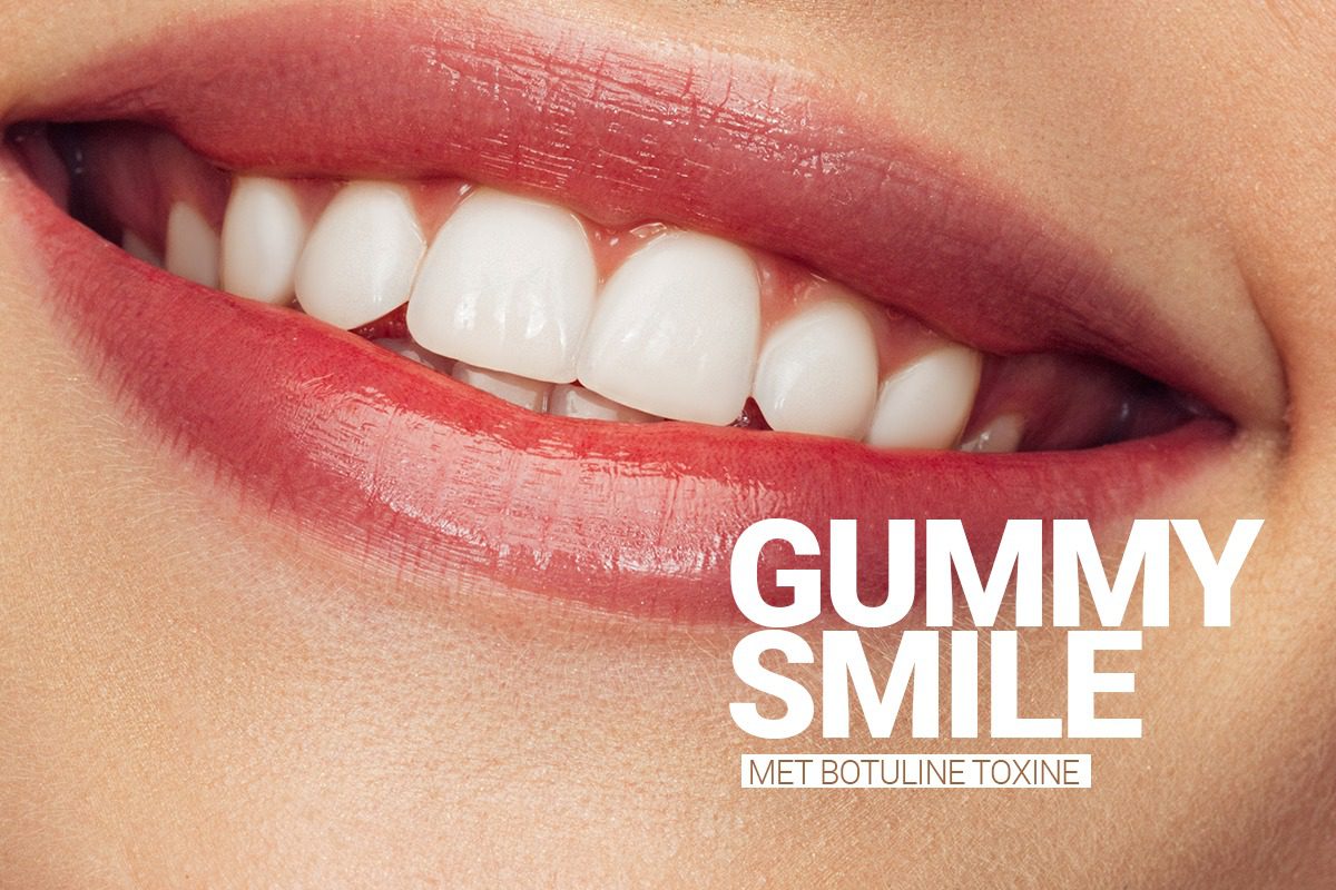 Gummy Smile